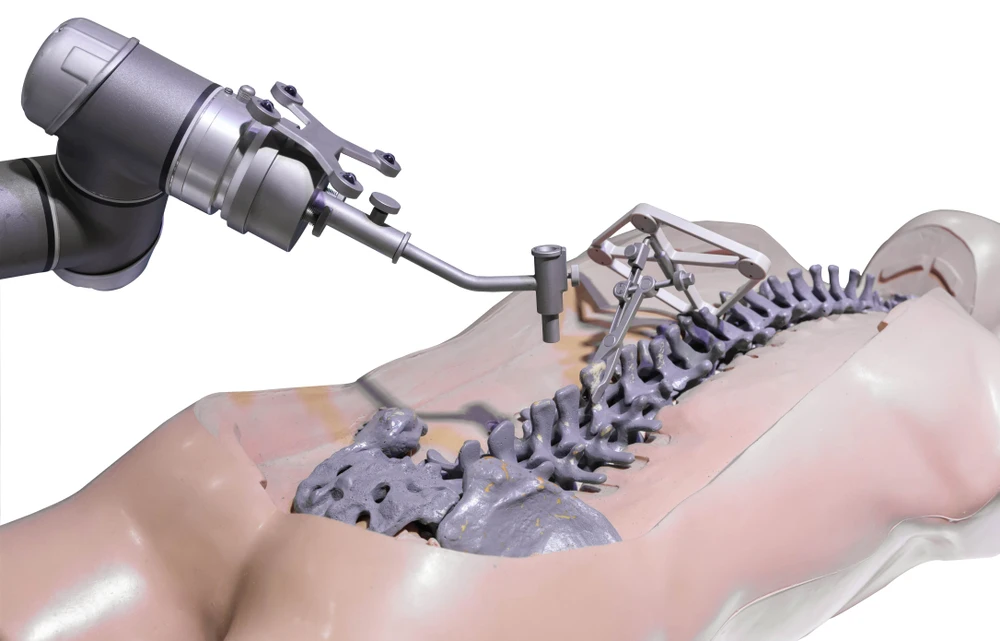 Imagem sobre a indicação para a cirurgia robótica da coluna